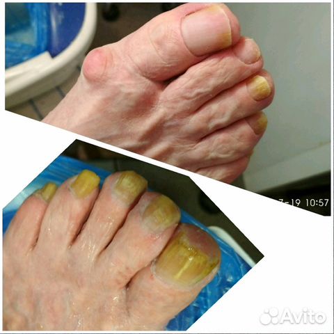 Обработка стоп пожилым людям