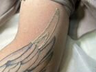 Удаление татуажа татуировок неодимовым лазером